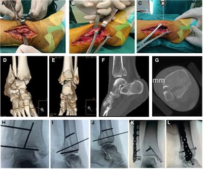 Treatment outcomes of posterior pilon fractures using a simple single lateral approach via stretching fibular fracture line